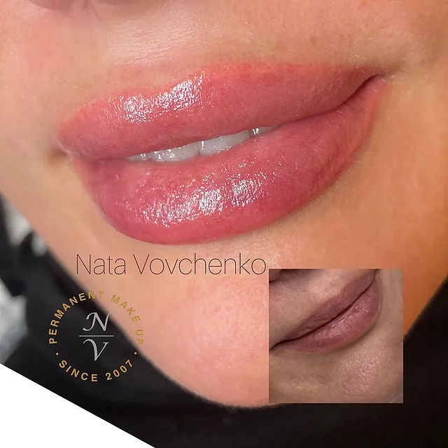 fillers läppar