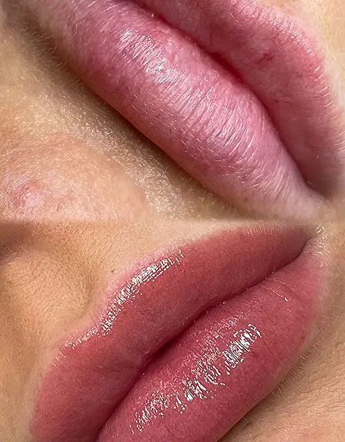 fillers läppar